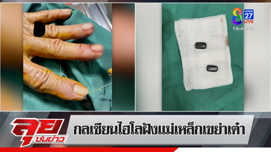 เซียนพนัน ฝังแม่เหล็กที่นิ้วกว่า 40 ปี